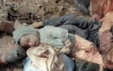 Iranian Children – 1987 – Saddam's Crime – Chemical Attack on Sardasht